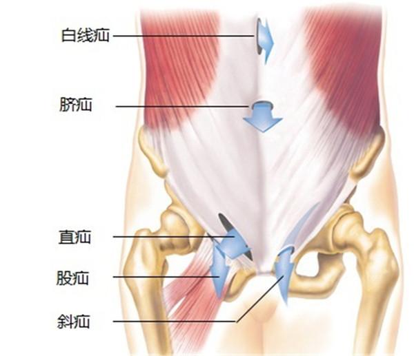 腹股沟直疝为腹股沟区可复性肿块,位于耻骨结节外上方,呈半球形,多无