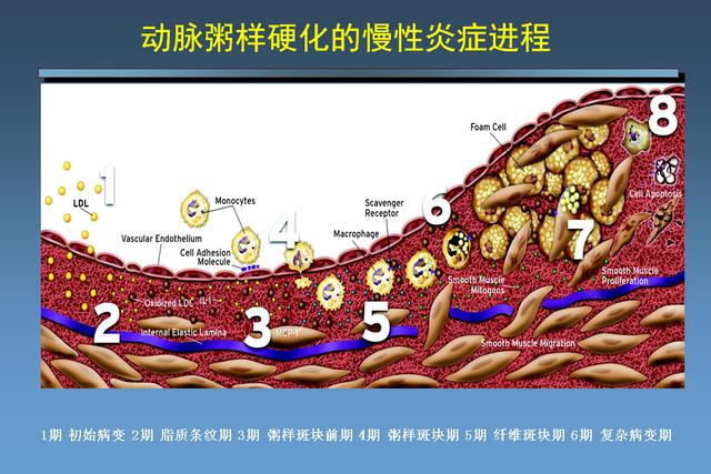 动脉粥样硬化的形成的机理