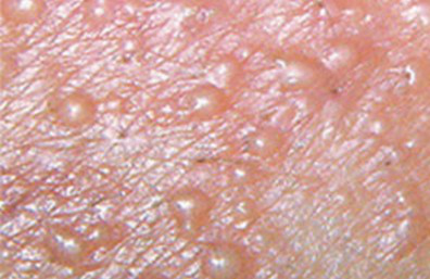 湿疹手上起水泡怎么办快速治愈水疱型湿疹不复发