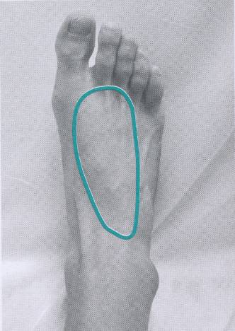 脚背腱鞘炎位置图片图片