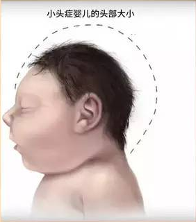 婴儿4个月小头症图片图片
