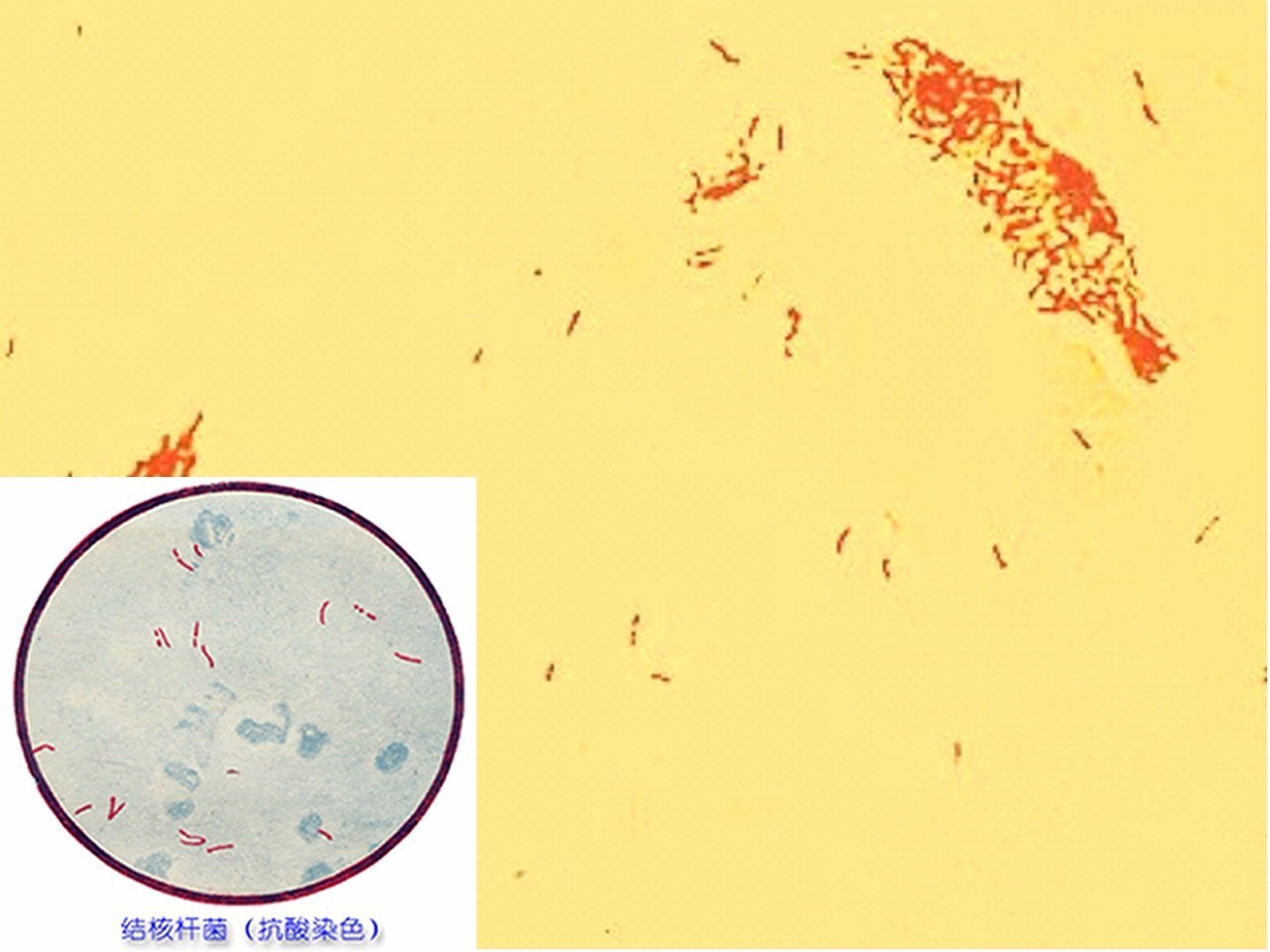 结核杆菌显微镜下图片图片