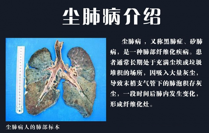 尘肺和肺癌的区别有哪些？