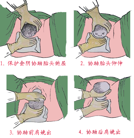 顺产图解全过程图片