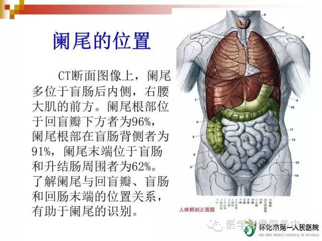 急性阑尾炎的ct诊断简单易懂