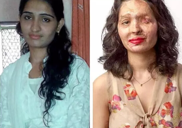 印度被硫酸毁容女孩reshma ruereshi走上纽约时装周