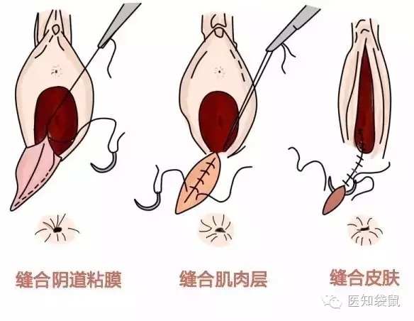 宫颈口裂开图片图片