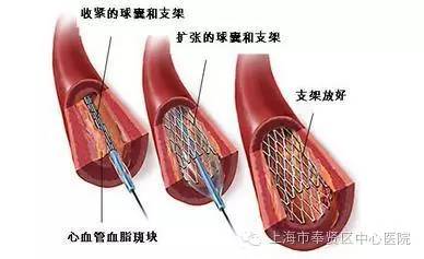 胆道支架植入术图片