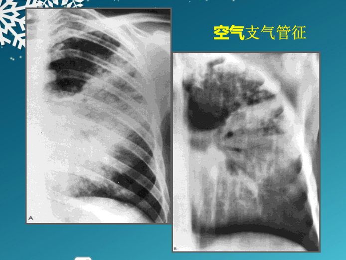 大叶性肺炎的ct表现   答:①病变呈大叶性或肺段性分布②病变中