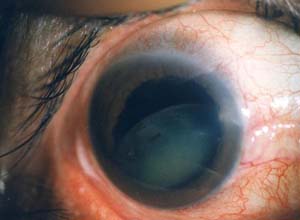 青光眼早期症状表现