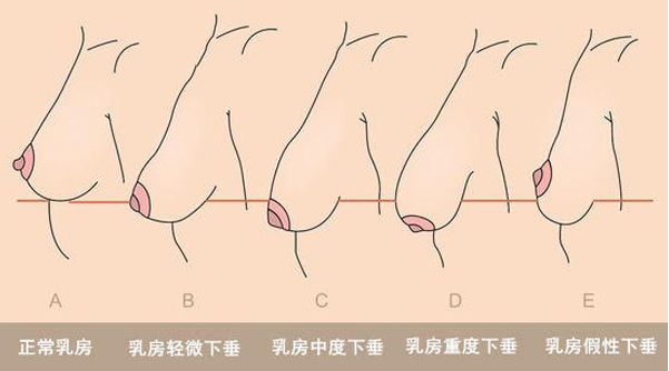 大而下垂的乳房,由于乳房的重力作用,可出现巨乳症的某些症状,如胸