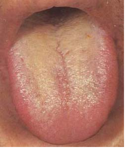 胃火旺的舌头图片图片
