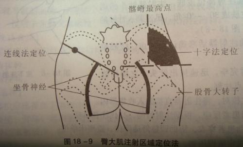 臀大肌注射部位示意图图片