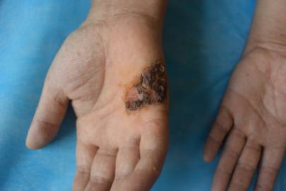 慢性砷中毒皮肤图片图片