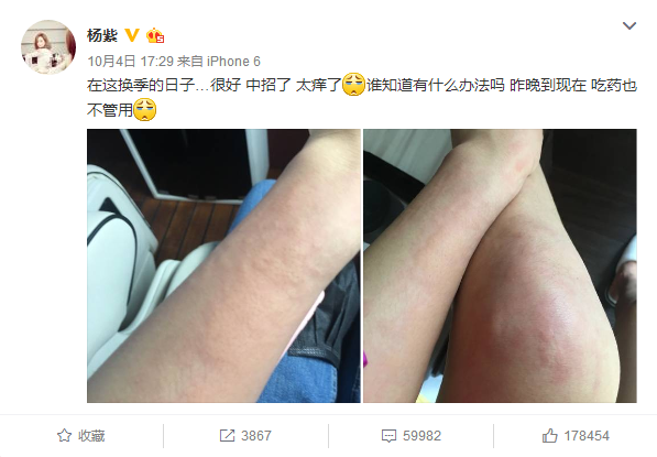 杨紫的荨麻疹吓坏众人