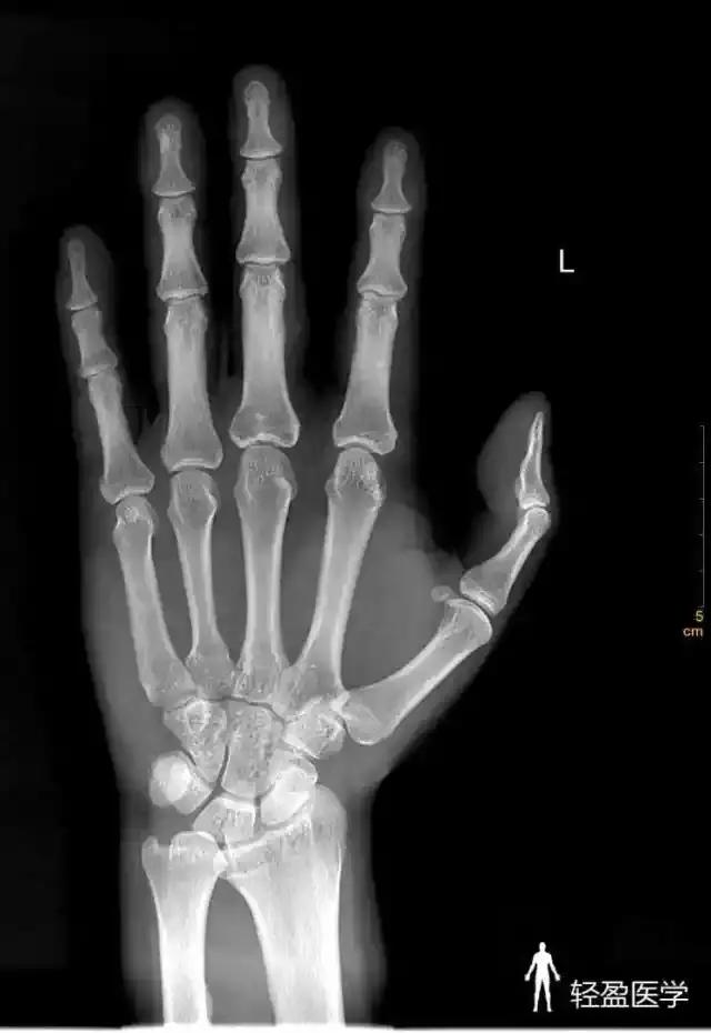 轻盈医学丨44岁男性,左手中指扭伤