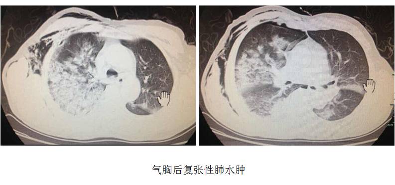 液气胸放了气却迎来了新麻烦