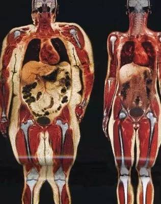 内脏脂肪和皮下脂肪图图片
