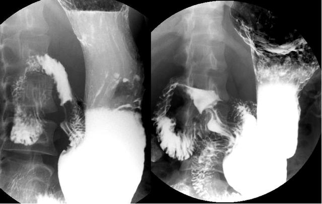 胃溃疡x线表现图片