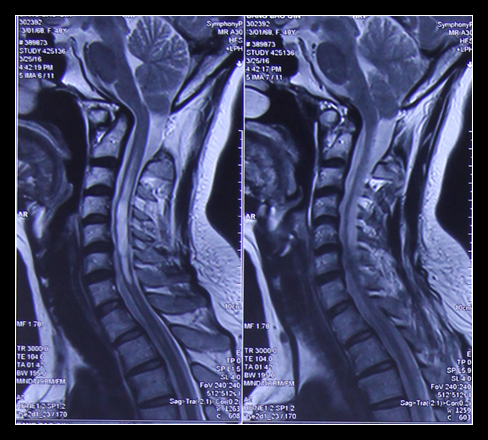 手术治愈35年病史寰枢椎脱位 小脑扁桃体下疝患者