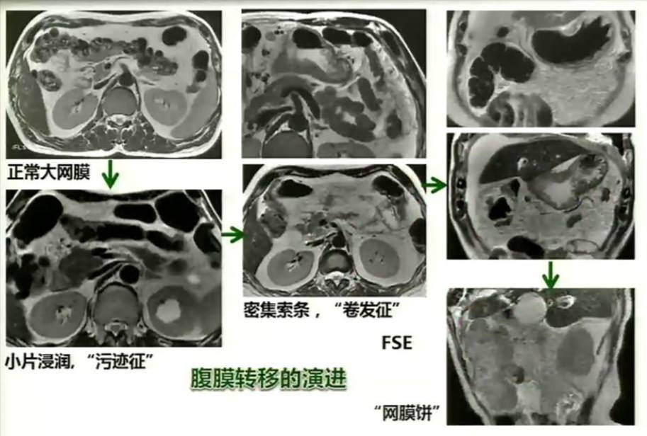 最全胃癌腹膜转移诊断攻略