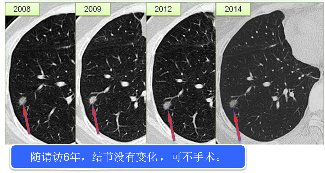 肺部发现小结节怎么办