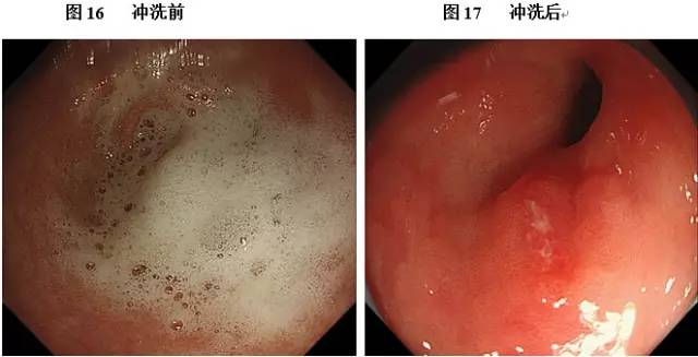 尽量充气至大弯皱襞完全展平(参见图4),观察胃底,胃体,胃窦时尽量拍摄