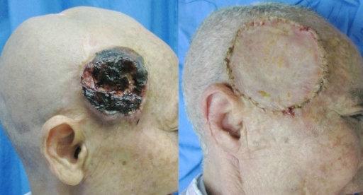 皮肤鳞状细胞癌的诊治