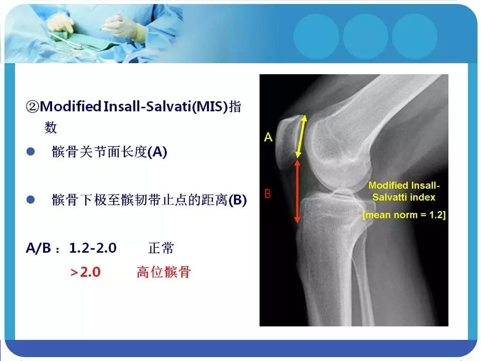 髌骨高位诊断标准图片