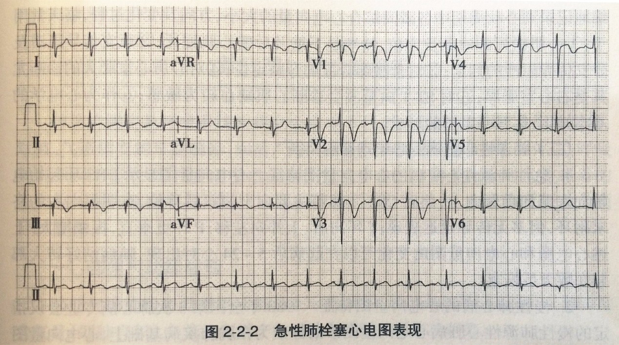 可出現v1-v4的t波倒置和st段異常,完全或不完全性右束支傳導阻滯,sⅠq