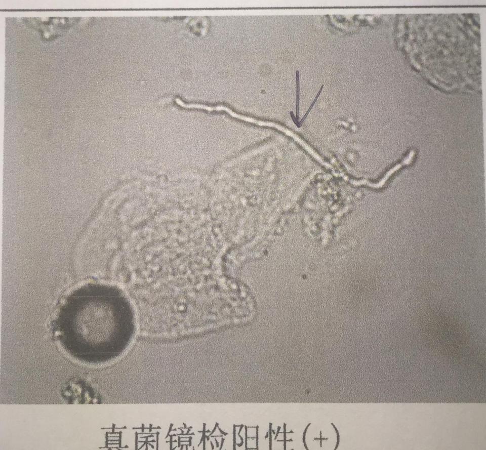 脚气真菌显微镜下照片图片