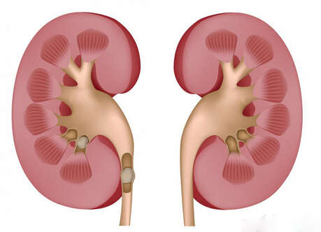肾萎缩的最佳治疗方法
