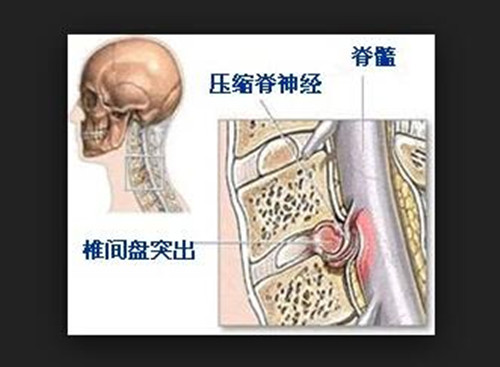 颈椎间盘突出吃中药缓解是什么原理 我爱原理网