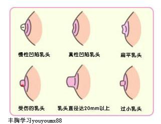 先天性乳头凹陷的原因:1,乳头和乳晕的平滑肌发育不良:乳头有输乳管的