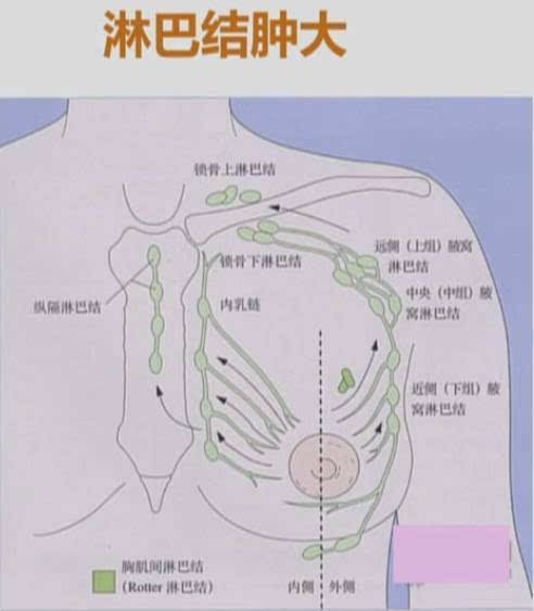 乳腺癌的患者60%以上会发生同侧腋窝淋巴结转移,而发生胸骨旁淋巴结的