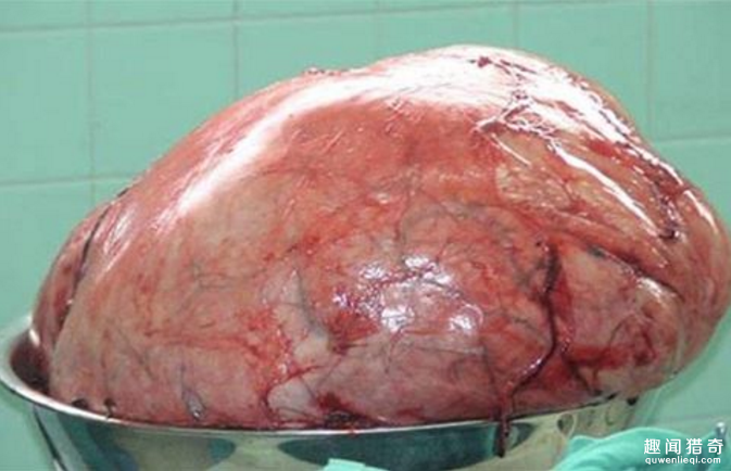 世界上最大肿瘤图片