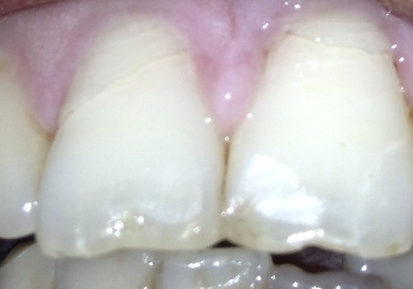 门牙裂纹图片