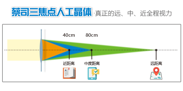 相较于传统的人工晶体,蔡司三焦点晶体完美自然的中距离视力,更能帮助