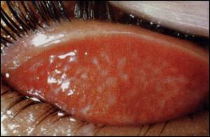 沙眼沙眼是由沙眼衣原体所引起的一种慢性传染性角膜结膜炎,沙眼