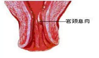 宫颈息肉有哪些症状图片
