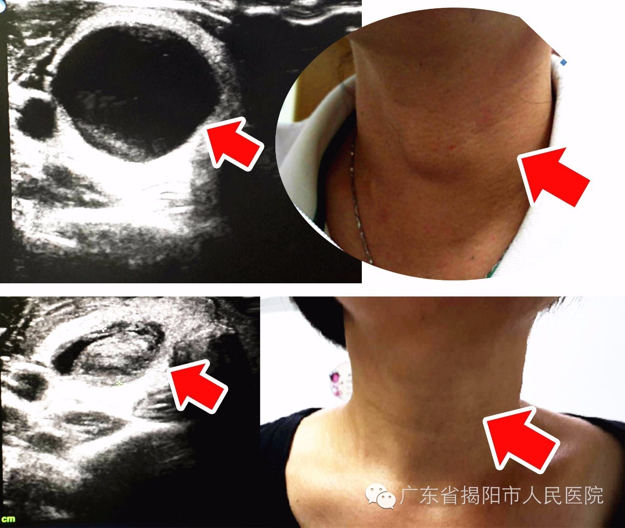 甲狀腺囊腫怎麼辦? 無疼痛無疤痕 