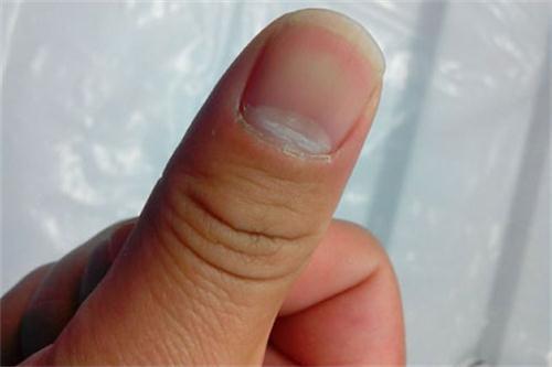 指甲月牙处凹陷的图片图片