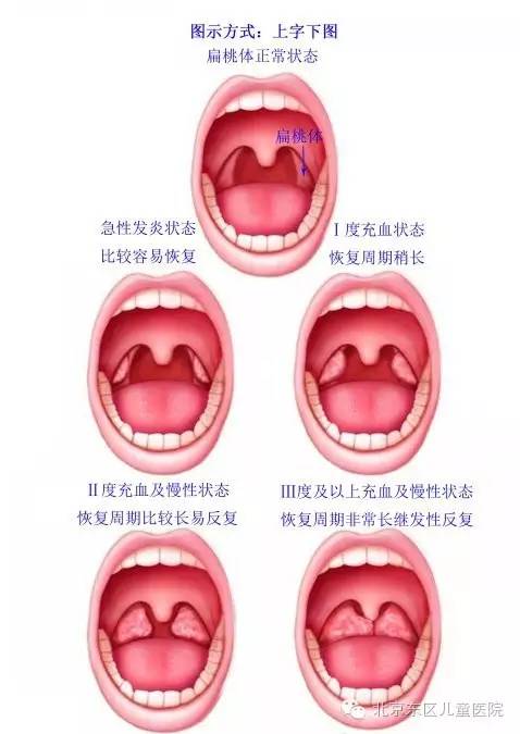 答:扁桃體目錄扁桃體扁桃體可以被切除的情況扁桃體不宜被切除的幾種