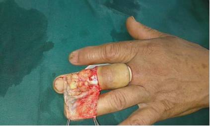 手指癌图片图片