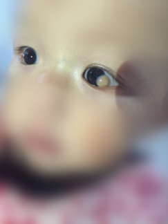 8个月宝宝结膜炎图片图片