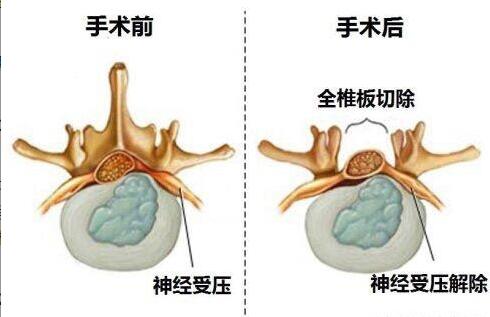 实用知识 对腰间盘突出的几点建议及自我恢复方法