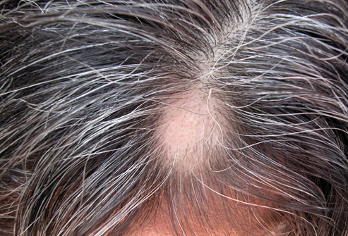 图文盘点女性脱发的10种可能原因