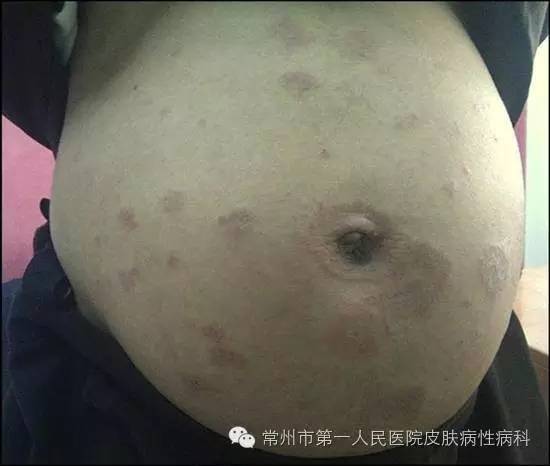 7个月孕妇起疱疹图片图片