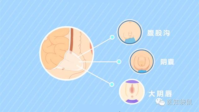 2,如何区别疝气和鞘膜积液?