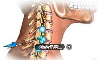 docx 关于颈椎骨质增生问:一直背部疼痛,去医院检查,被告知为骨质增生
